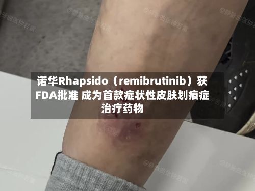 诺华Rhapsido（remibrutinib）获FDA批准 成为首款症状性皮肤划痕症治疗药物-第2张图片