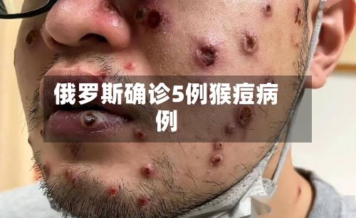 俄罗斯确诊5例猴痘病例