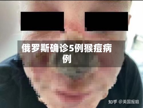 俄罗斯确诊5例猴痘病例-第2张图片